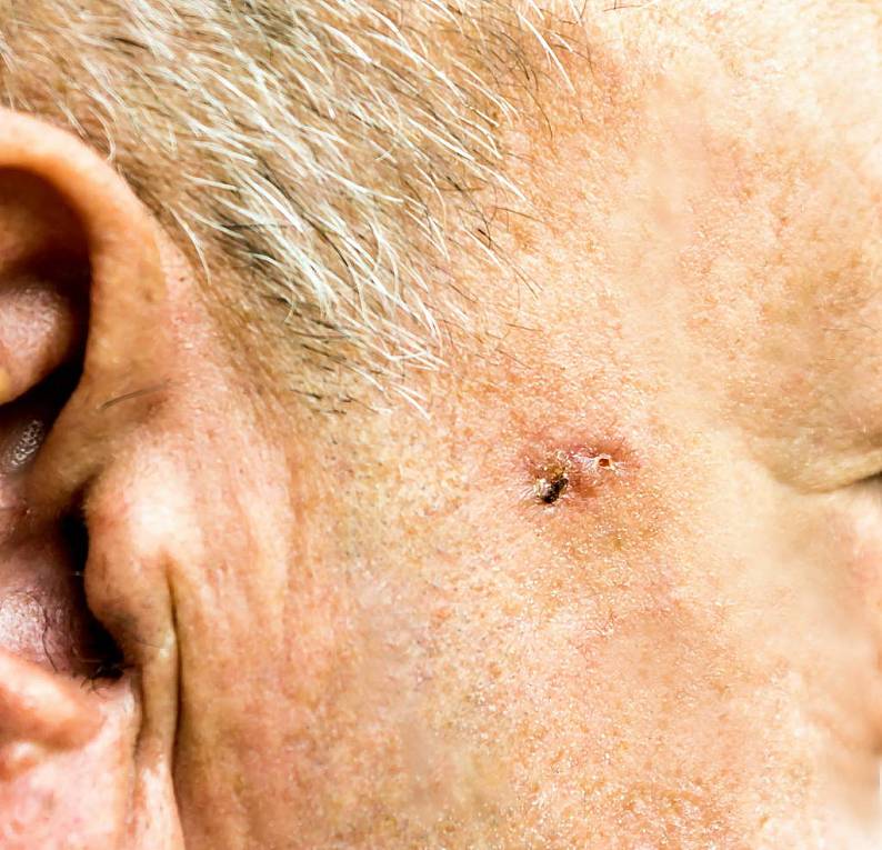 细胞,癌,脸,老人,外科手术,特写_高清图片_全景视觉