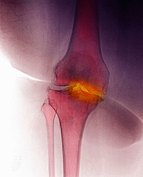 x光,膝,展示,关节炎