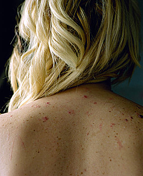 背影,头部,肩部,金发,女孩,结疤,痤疮,2007年