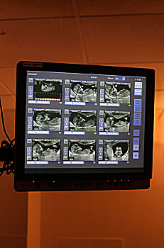 超声波,图像,胎儿,老化,两个月