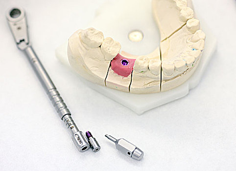 牙齿,移植,器具