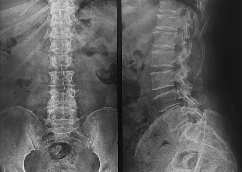 正常脊椎骨ct图片图片