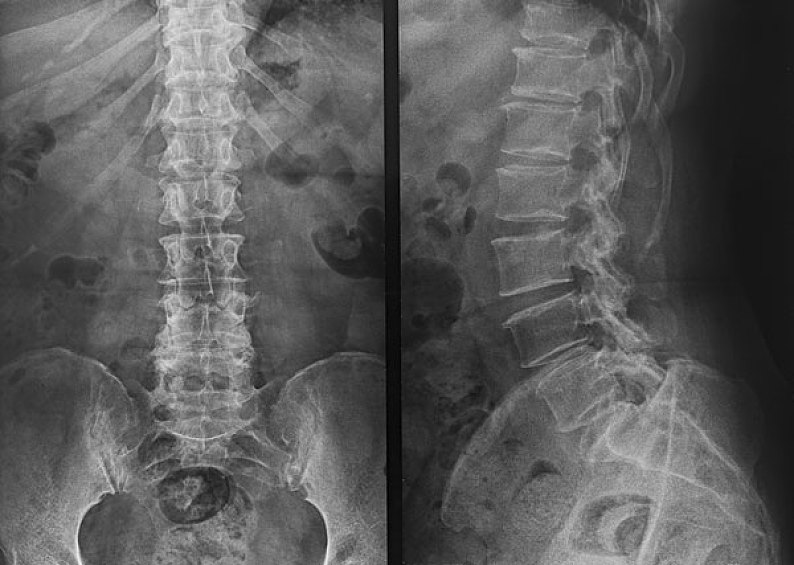 全脊柱x光片侧位图片