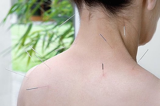 针灸,人,背影