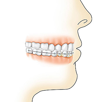 牙龈,牙套,牌匾,牙齿