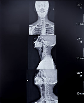 颈椎x光片