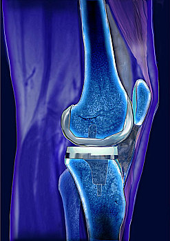 膝,关节,假肢,ct扫描