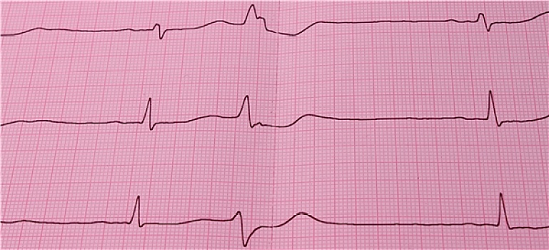 心电图