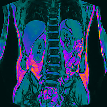 正面,腹部,核磁共振扫描,60岁,男患者,肾脏,石头