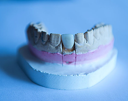 模制,牙齿,石膏,实验室