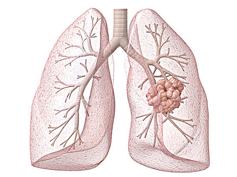 肺,癌症