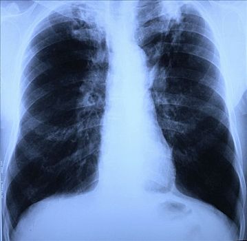 x光,肺,胸部,肺结核