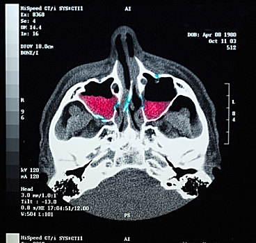 ct扫描,扫瞄,脸,骨头,展示,骨折