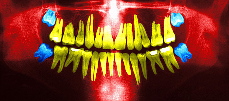 正常的牙齿全景图图片