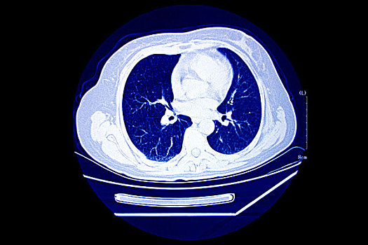 ct扫描断层影像图