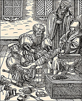截肢,腿,16世纪,历史,插画