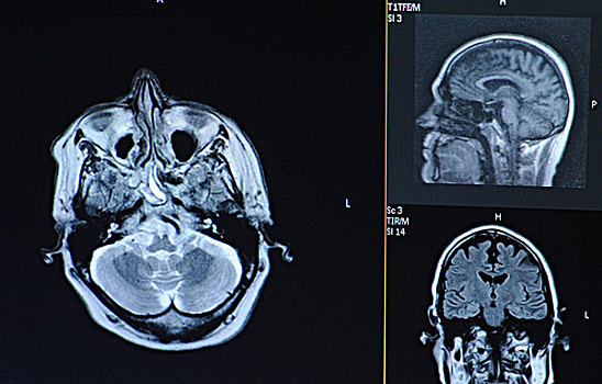 磁共振成像,核磁共振成像,头骨