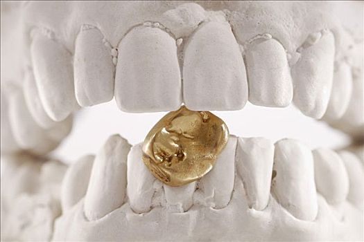 牙齿,金色,皇冠,黄金