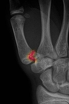 x光,展示,骨折,大拇指