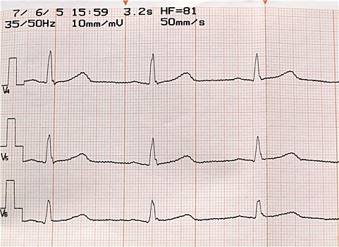 心电图