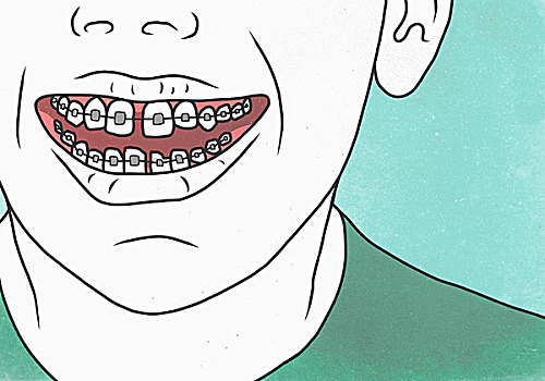 插画,男人,牙套,牙齿保健