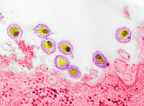 透射电子显微图,艾滋病