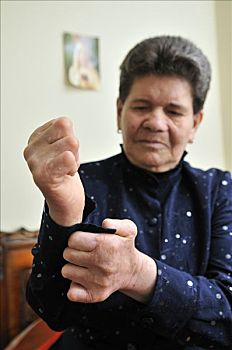 病人,72岁,残废,手,特写,扣,波哥大,哥伦比亚,南美