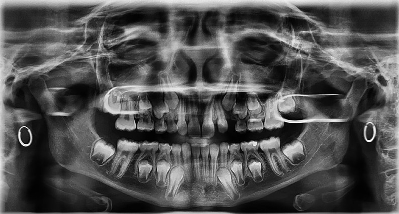 儿童换牙前x光片图片