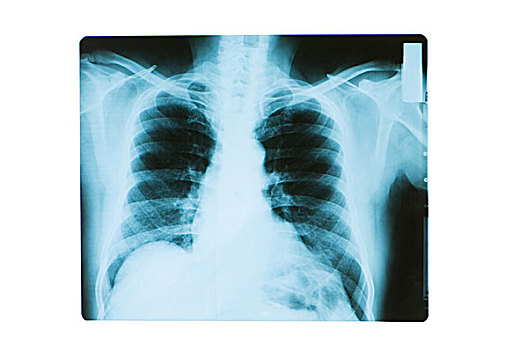 x光片,胸部,骨头,成年