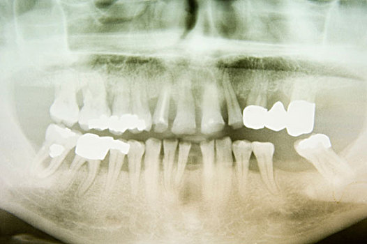 x光片,人,颚部,牙齿,德国,欧洲