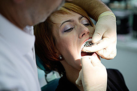 女人,39岁,牙科检查,牙科手术,牙齿,印记,牙套
