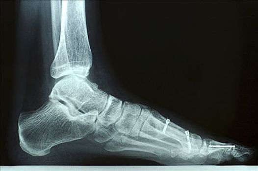x光,照片,左边,脚,外科手术,螺丝,五金