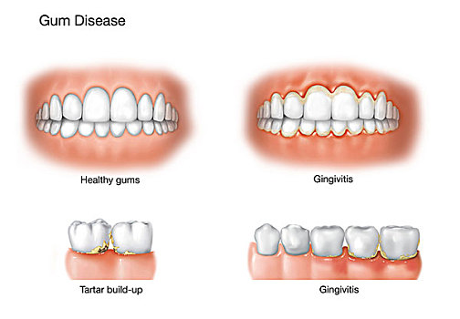 对比,健康,牙龈