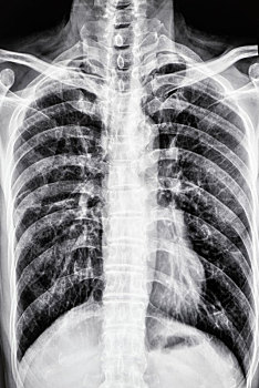 胸部x光影像