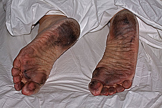 世界上最脏的脚图片