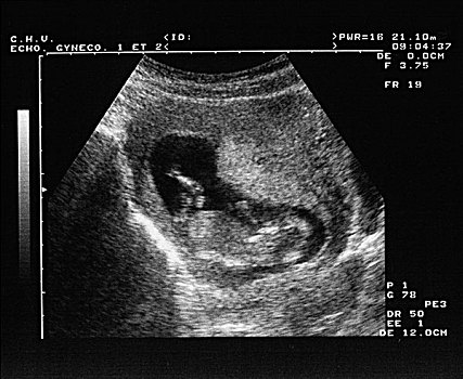 黑白,超声波扫描,2个月大,胎儿