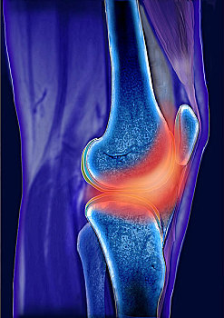 膝,关节,区域,痛苦,ct扫描