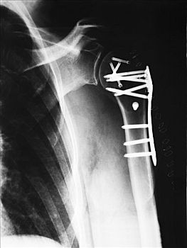 x光,破损,上臂,外科手术,展示,盘子,螺丝,女人
