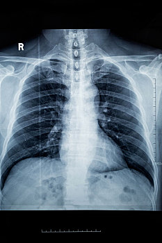 胸腔ct正常图片图片