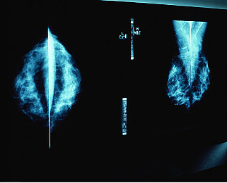 乳腺癌的图片
