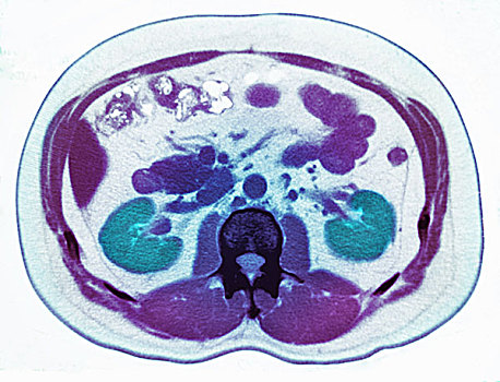 ct扫描,扫瞄,展示,肾脏,石头