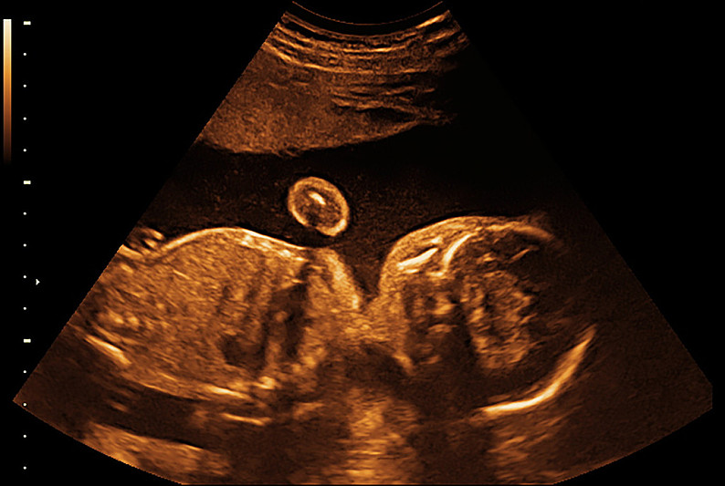 X光片婴儿图片