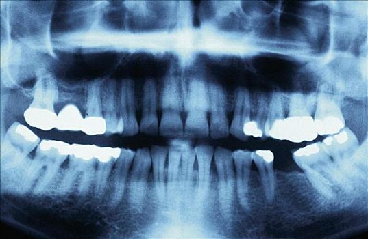 x光,填料,人,堵塞,骨头,放射学,牙科