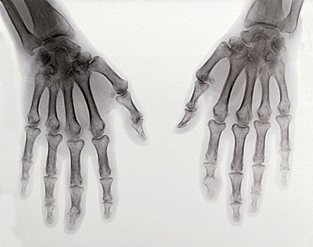 x光,两只,手,展示,关节炎