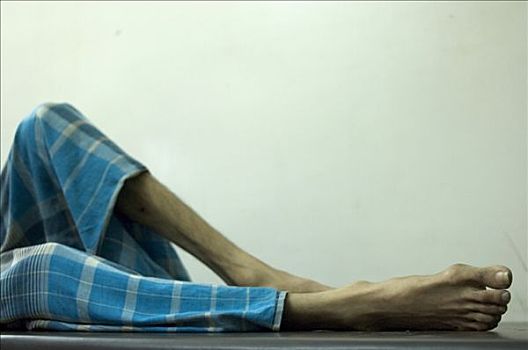 腿,肺结核,家,特别,诊所,西孟加拉,印度