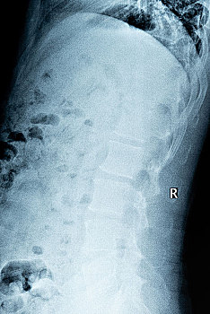 腰椎轻度骨质增生的x光片