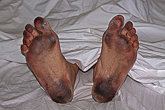 世界上最脏的脚图片