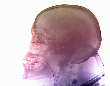 头骨,x光,男人,摩托车,意外