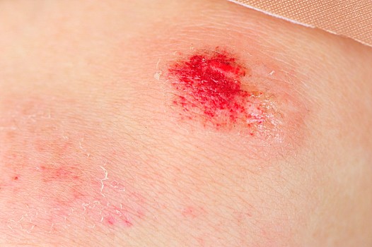 运动,受伤,膝,女人