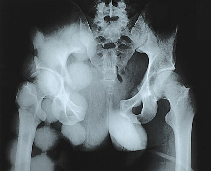 x光片,骨盆,骨折